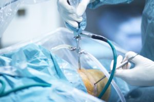 Orthopaedic surgeons Operates Arthroscopic Knee Surgery on Patient