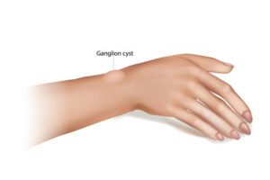 Ganglion Cyst of the Wrist and Hand. Synovial cyst or a Gideon s Disease, or a Bible Cyst, or a Bible Bump. Vector illustration