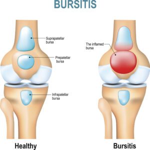 Bursitis. Healthy knee and knee with bursitis