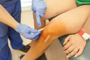 Doctor putting steri strips on incisions one day after arthroscopic knee surgery for a torn meniscus