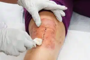 Nurse is changing bandage to a patient after knee operation