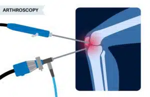 Knee joint arthroscopy Surgery