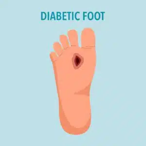 Diabetic foot syndrome